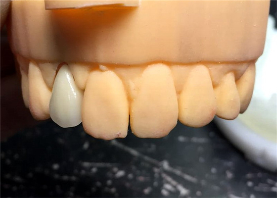 Tand de Kroonbrug Goede Biocompatibility van de Chromecastveiligheid PFM