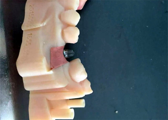 CAD / CAM PFM Tandkronen Brug Hars Materiaal Goede biocompatibiliteit Stabiliteit