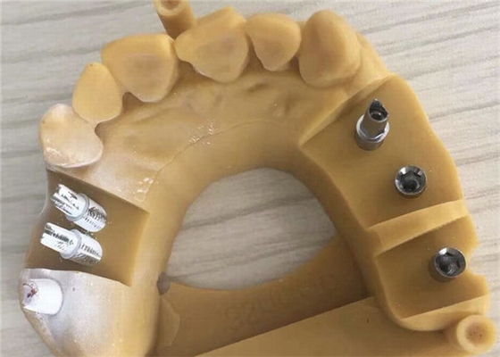 De digitale van de de Kroon 3D Druk van Biocompatibility PFM Tand Tijdelijke Kronen