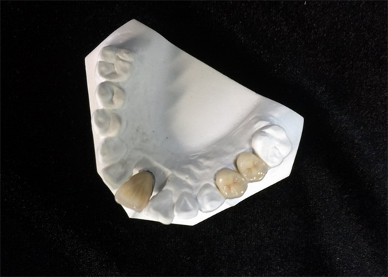 Hoge Natuurlijke Bestand de Tandvlek van de Stabiliteits Ceramische Tandpfm Kroon
