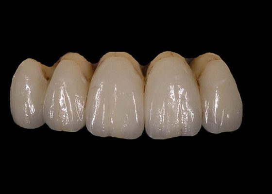 Gemakkelijk handhaaf Orthodontische PFM-de Kleurenstabiliteit van de Porselein Tandkroon