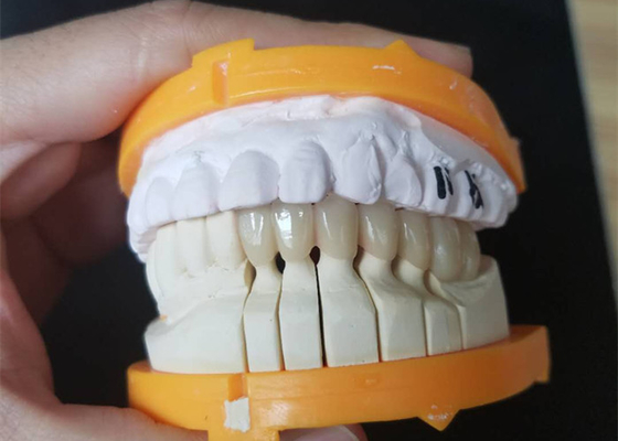 De Ceramische Kronen van de douanegrootte PFM voor Latere en Voorafgaande Tanden