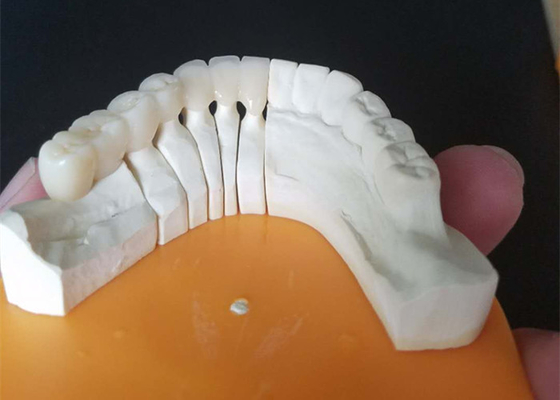 De Ceramische Kronen van de douanegrootte PFM voor Latere en Voorafgaande Tanden