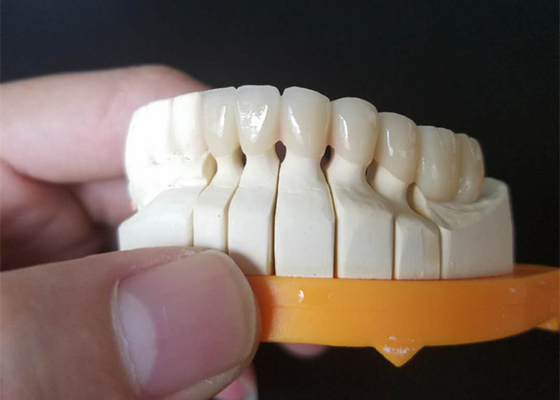 De Ceramische Kronen van de douanegrootte PFM voor Latere en Voorafgaande Tanden