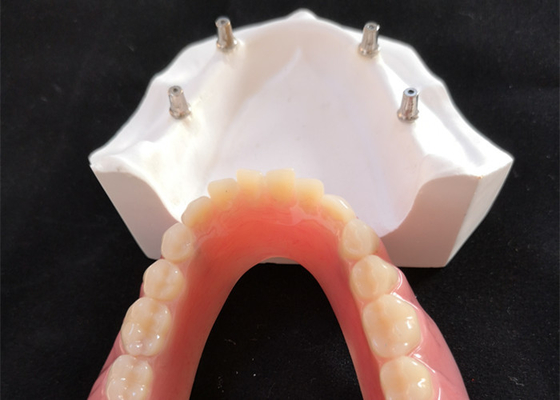 Comfortabele CAD CAM Tandimplant Gemakkelijke Overdenture handhaaft