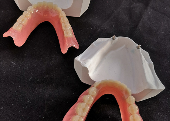 Comfortabele CAD CAM Tandimplant Gemakkelijke Overdenture handhaaft