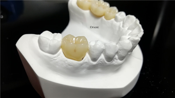 Keramische tandheelkundige kroon, Zirconia tandheelkundige kroon