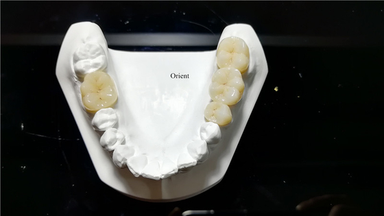Keramische tandheelkundige kroon, Zirconia tandheelkundige kroon