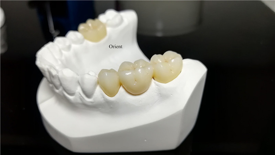 Keramische tandheelkundige kroon, Zirconia tandheelkundige kroon