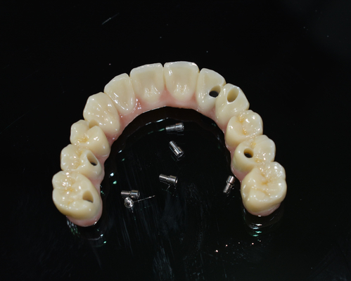 Tandkronen van zirconia: natuurlijke tanden, duurzaam en veilig