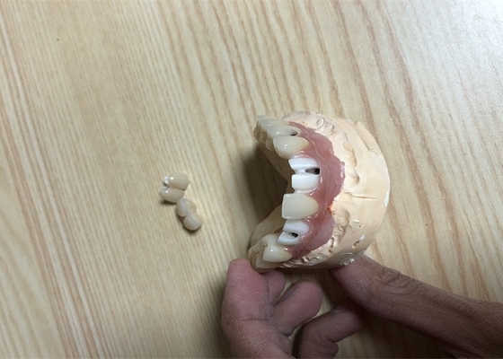 Nauwkeurige Implant van Biocompatibility Tandimplant van de Gehechtheidstand Kroon