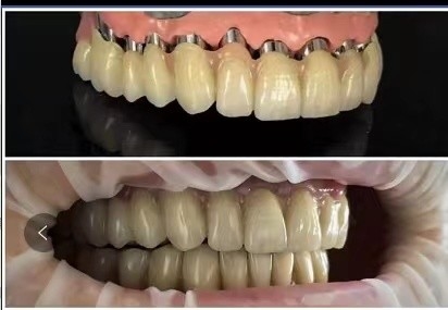 Tandheelkundige implantaten Telescoop PFM porseleinen brug