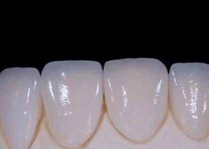 EMAX Duurzaamheid CAD/CAM tandheelkundige composiet veneers zeer gedetailleerd nauwkeurig