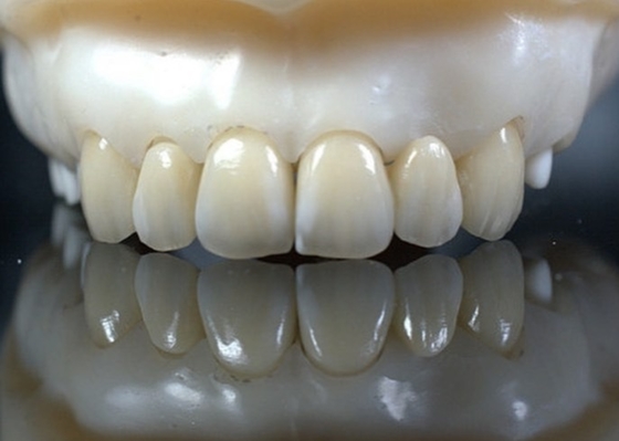 EMAX Duurzaamheid CAD/CAM tandheelkundige composiet veneers zeer gedetailleerd nauwkeurig