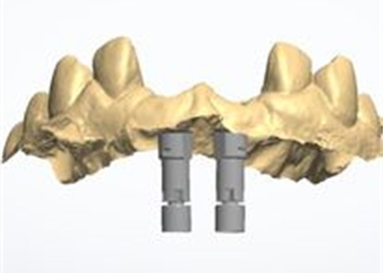 Precieze CAD/CAM-ontwerp Zirconia tandkroon voor montage