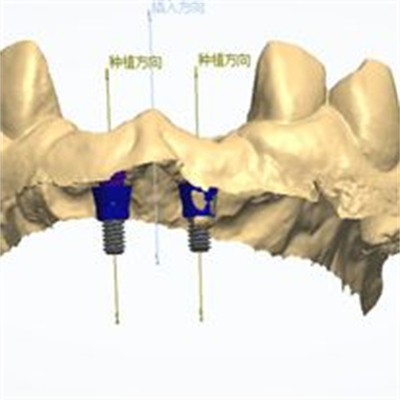 Precieze CAD/CAM-ontwerp Zirconia tandkroon voor montage