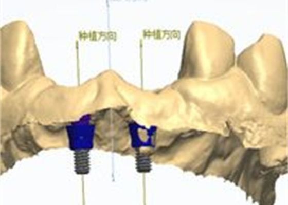 3D-model Zirconia kroon