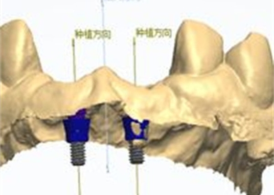 Precieze CAD/CAM-ontwerp Zirconia tandkroon voor montage