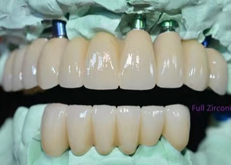 OEM Implantat Zirconia Tandheelkundige Kroon Vaste Brug