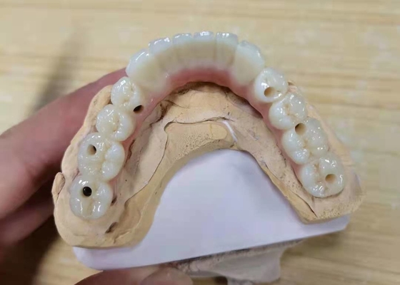 FDA Alle Zirconia kroon met implantaat ondersteunde tandheelkundige prothesen voor tandheelkundig laboratorium