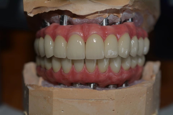 Precieze tandheelkundige implantatenkronen voor comfort en vertrouwen
