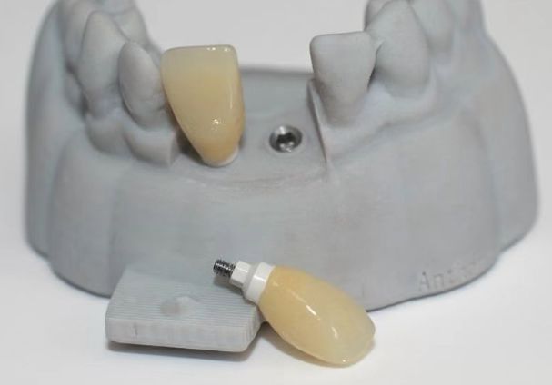 CAD PEEK op maat gemaakte abutment