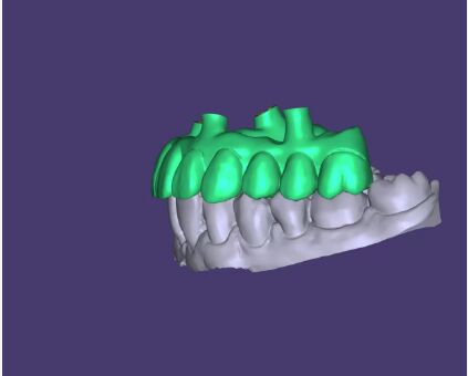 Design AOX Professional Full Arch Implant Bridge Design Service